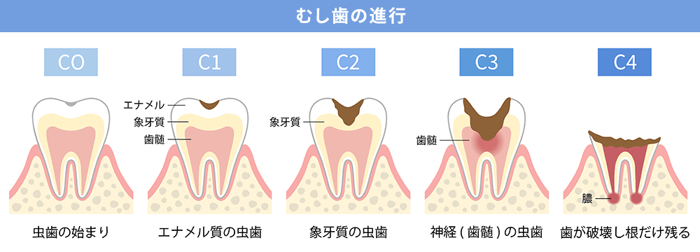 むし歯の進行