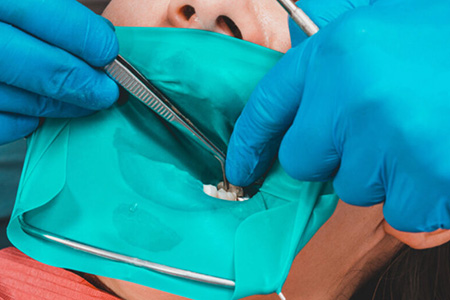 ラバーダム防湿