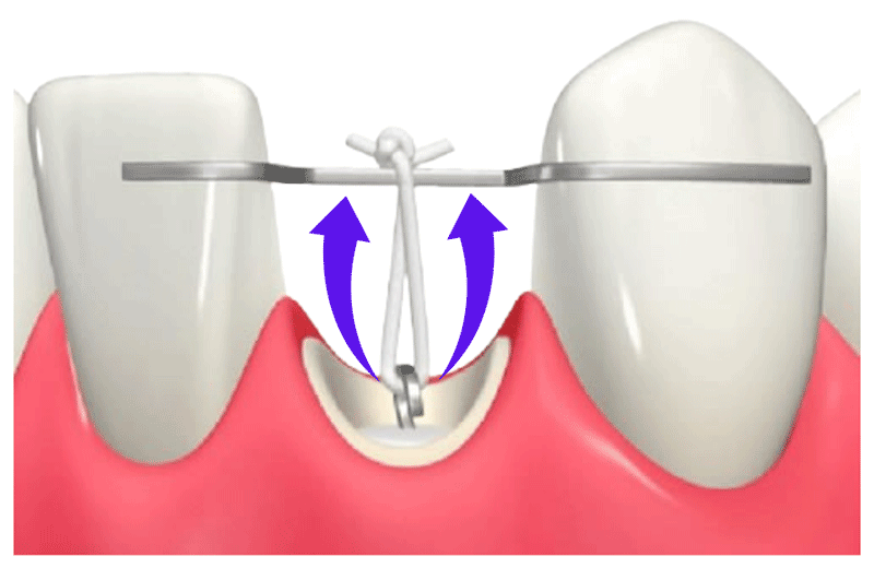 エクストルージョンのイメージ画像