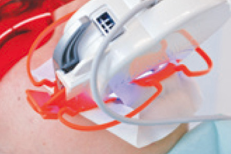 光を照射して薬剤を活性化