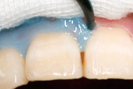 歯ぐきを保護するレジンを塗布