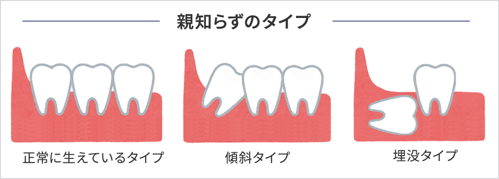 親知らずの種類