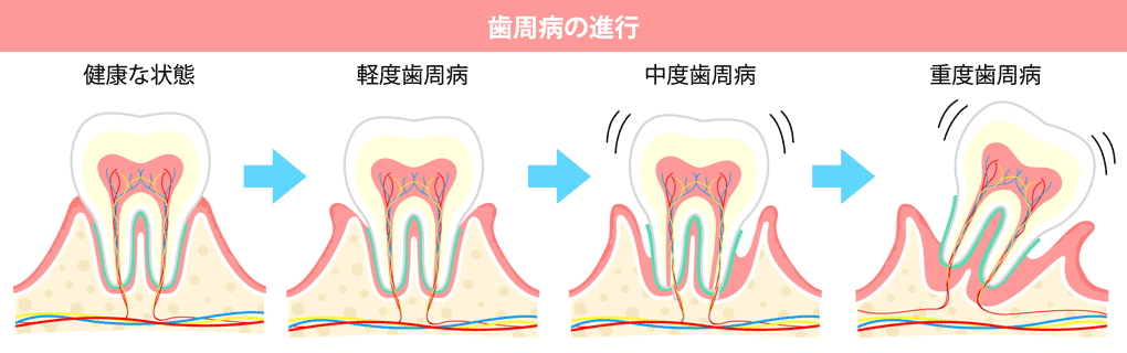 歯周病の進行