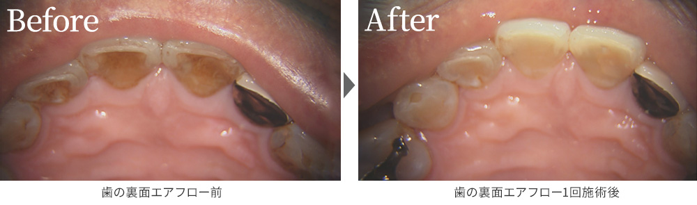 クリーニングの症例写真