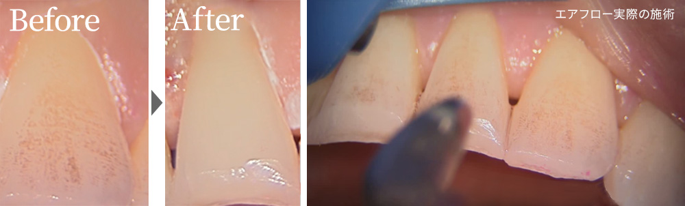 エアフローの施術写真・症例写真