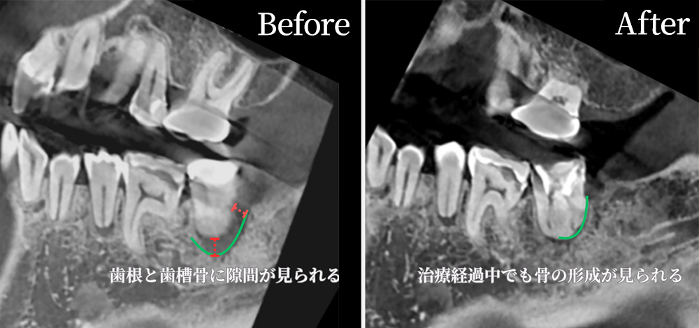 根管治療の症例写真