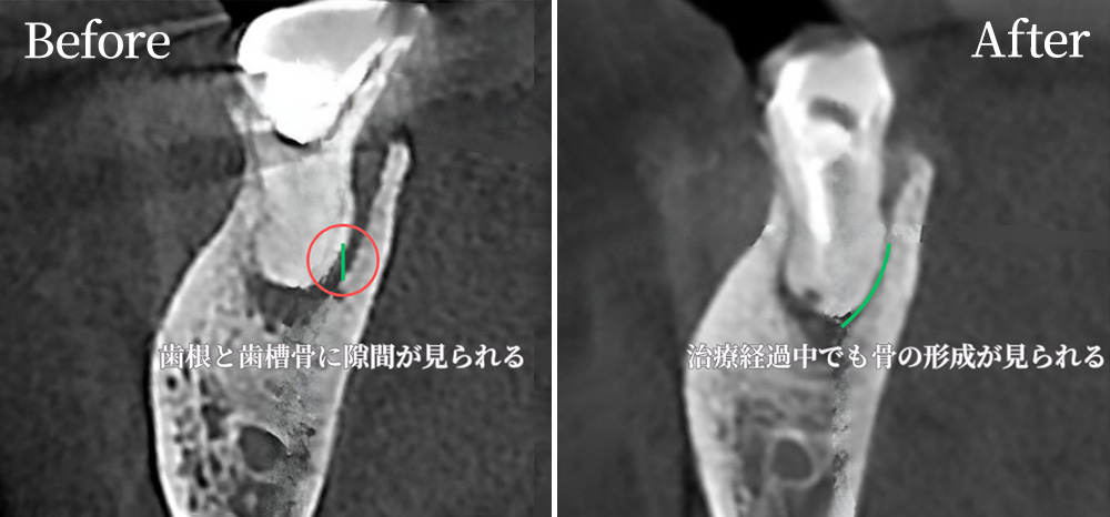 根管治療の症例写真