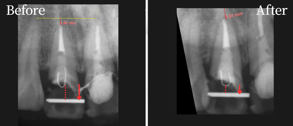 拠出処置（エクストルージョン）の症例写真