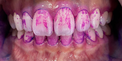 染色液を使用した染め出し