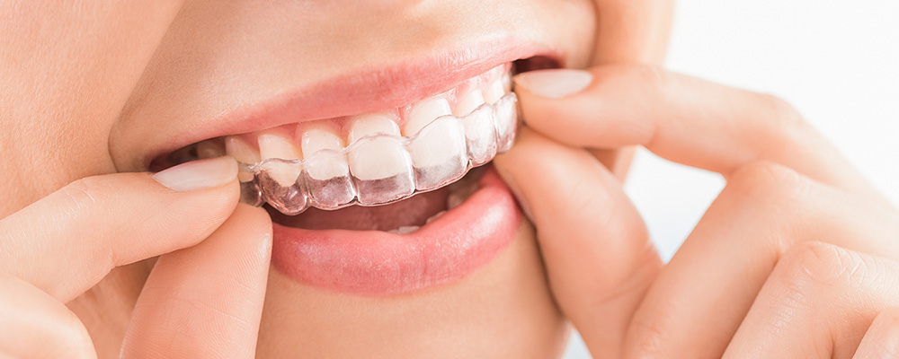 ホームホワイトニングのマウスピース