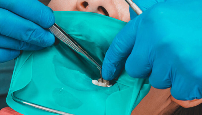 ラバーダム防湿