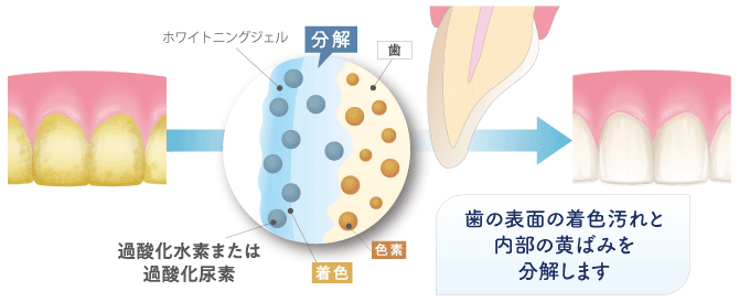 歯の表面の着色汚れと内部の黄ばみを分解します